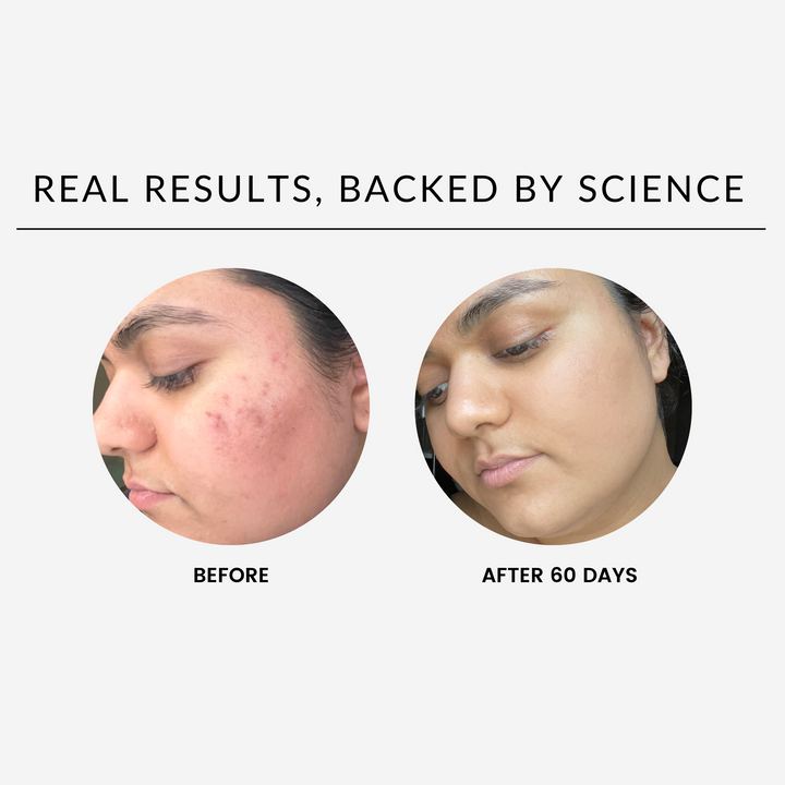 Before and after results of using the Overnight Glow Up Mask for 60 days, showing improved skin clarity and reduced acne marks.